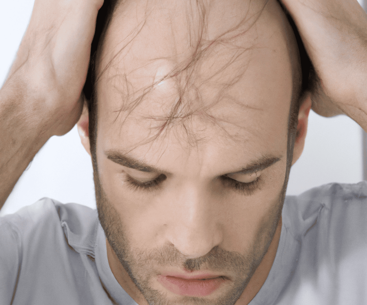 Alopecia Sufferers Increasingly Turning to Turkey for Hair Transplant Treatment